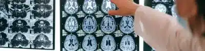 MRI Scan